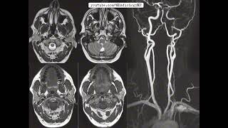 Case 98 with Horners syndrome [upl. by Sedaiuqlem908]