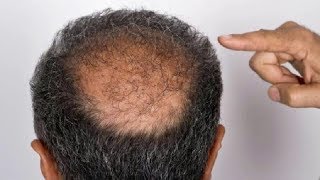 CURE BALDNESS And HOW TO REGROW HAIR NATURALLY without Transplant Surgery [upl. by Suzan]