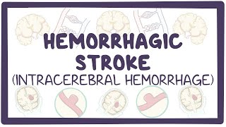 Hemorrhagic stroke intracerebral hemorrhage  causes symptoms diagnosis treatment pathology [upl. by Eugenie]