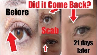 Xanthelasma Treatment  Dermawave Skin Clinic Panipat  Patna  Jammu  Kurukshetra  New Delhi [upl. by Nahn224]