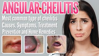 Angular Cheilitis Causes Symptoms Treatment Prevention and Home Remedies  Perleche Stomatitis [upl. by Asante894]