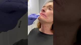 Botox for platysmal bands in the neck [upl. by Doxia]