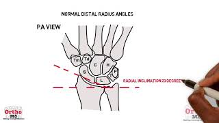 Radiographic features  Normal distal radius angles [upl. by Isabeau]