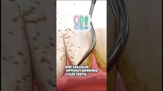 Scaling teeth ruin your tooth enamelWatch full video on our channelscalingteeth cleaning [upl. by Barrett]