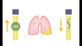 Differentiating transudative and exudative effusions transudate vs exudate [upl. by Cherlyn]