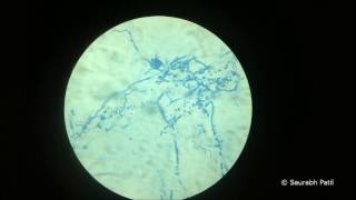 Trichophyton rubrum Lactophenol cotton blue mount [upl. by Lynnelle]