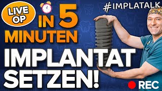 So wird ein ZAHNIMPLANTAT in 5 Minuten eingesetzt ✅ Alle Schritte einfach erklärt [upl. by Ladiv]