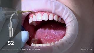 PROPHYLAXIS  CASE REPORT  Supragingival scaling and airpolishing Dr Daniele Brondo [upl. by Auqinet]