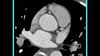 Cardiac 3D and 4D mapping of a coronary CTA 6 of 6 [upl. by Suirrad280]