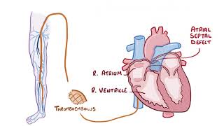 Pulmonary Embolisms causes symptoms diagnosis treatment pathology [upl. by Ymassej19]