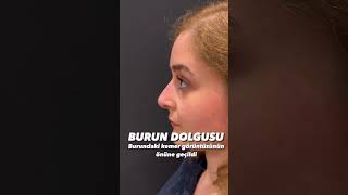 Burun Dolgusu  Özel DRM Polikliniği [upl. by Anifesoj]