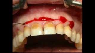 Gingival Surgery  External Bevel [upl. by Enihpesoj]