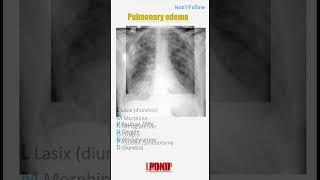 Mnemonic for treatment of Pulmonary edema [upl. by Mylo]