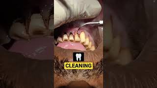 Teeth cleaning  Dental Scaling  scaling dental scaling [upl. by Inaffyt583]