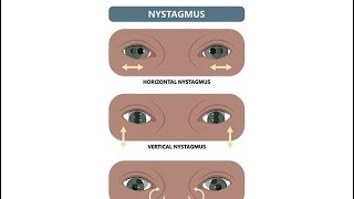 Nystagmus spontaneous Eye movement disorders and Saccadic intrusion Causes and possible treatment [upl. by Aseena]