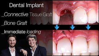 Dental Implant front teeth Extraction  Implant  Connective Tissue  Bone Graft Immediate loading [upl. by Enellij]