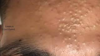 Forehead Acne amp Blackhead Treatment  Blackhead Removal on forehead removeblackhead [upl. by Airdnoed]