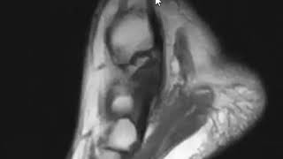 Sinus tarsi syndrome and erosions of calcaneus [upl. by Esmond]