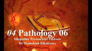 04 Retinal Pathology 06 Elkafrawy pathology باثولوجيالكفراوي Idiopathic premacular fibrosis [upl. by Nilloc]