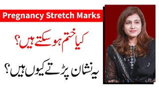 How to Remove Pregnancy Stretch Marks after Delivery  Dr Maryam Raana Gynaecologist [upl. by Sebbie]