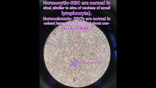 HematologyRBClymphocyte anaemia pathologymedical [upl. by Cahn713]