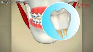 Teeth alignment using braces  How do braces work [upl. by Teak]