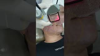 Como é o Laser fracionado CO2 para cicatrizes e rejuvenescimento  Dr Paulo Lu Dermatologista [upl. by Lacombe215]