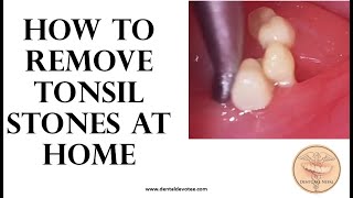 How to remove tonsil stones at home  Tonsil stone removal [upl. by Drucill]