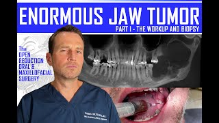 ENORMOUS JAW TUMOR  The Biopsy  PART 1 [upl. by Noied36]