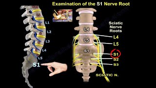 Examination Of S1 Nerve Root  Everything You Need To Know  Dr Nabil Ebraheim [upl. by Novled]