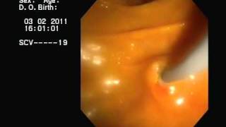 CPRE y drenaje de Colangitis Aguda ERCP acute cholangitis [upl. by Oruasi]