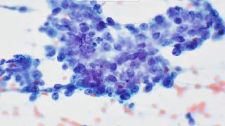 Cervical LN FNA Metastatic nasopharyngeal carcinoma [upl. by Ymeraj871]