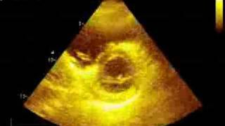 Pulmonary embolism echocardiography [upl. by Linette440]