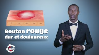 2mn pour comprendre LE FURONCLE du 27 Janvier 2020 [upl. by Peg]