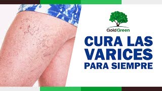 Salud a tu Día Varices en las Piernas  Como se Curan las Varices [upl. by Liahkim]