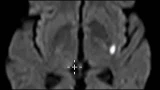 Acute lacunar infarction basal ganglia [upl. by Barker]