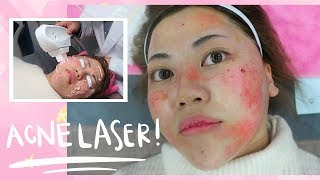 Painful ACNE LASER Experience in Korea [upl. by Burford]