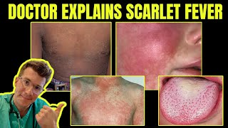 Doctor explains SCARLET FEVER Group A Streptococcal disease  CAUSES SYMPTOMS amp TREATMENT [upl. by Aliuqaj787]