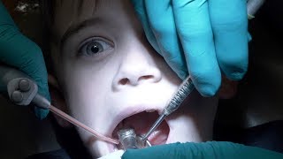 DENTAL HEALTH VLOG  HIS FIRST CAVITY FILLING  TWO CAVITIES [upl. by Whyte]