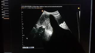 Adenomyosis Sonographic Findings [upl. by Melesa547]