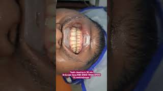 Teeth cleaning in Aurangabad teeth whitening by DrGunjan Garg scaling dentist drgunjangarg reel [upl. by Yesnik]