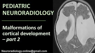 Pediatric Neuroradiology  Malformations of Cortical Development part 2 [upl. by Illom272]