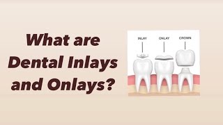 What are Dental Inlays and Onlays [upl. by Arhna506]