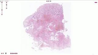 Choriocarcinoma  Histopathology [upl. by Animar]