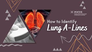 Ultrasound Lung A Lines 2 [upl. by Ykcin]