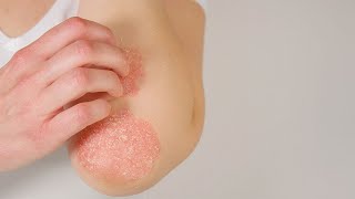 Tratamientos para la psoriasis [upl. by Netsrijk]