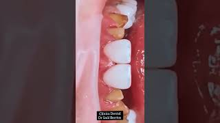 fundas de EMAX disilicato de litio dientes [upl. by Caressa]