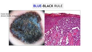 Nodular melanoma  Dr Ketty Peris [upl. by Nerraf]