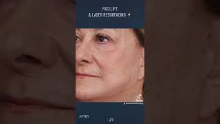 Unveiling the Magic of Facelift and Laser Resurfacing  Watch our Before and After Video [upl. by Rainger]