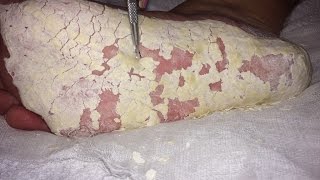 Extreme dry cracked feet skin removal after treatment [upl. by Erhart]